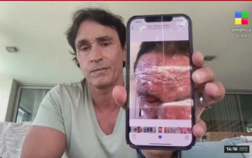 Sebastián Estevanez contó cómo fue la peor noche de su vida, después de haberse prendido fuego con alcohol