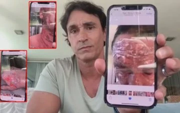 ¡Las imagenes más dramáticas del año! Sebastián Estevanez mostró las fotos que le sacaron horas después de quemarse la cara y las manos