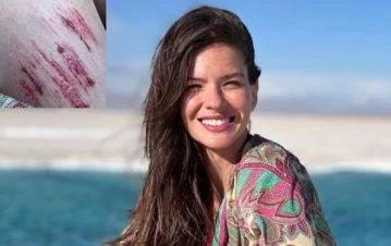 Cómo le quedó la pierna llena de cicatrices a la China Suárez después de un accidente que sufrió en Jujuy: las fotos