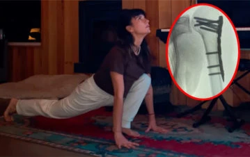 A 4 meses de su accidente, Gimena Accardi reveló cómo le quedó su hombro tras la operación