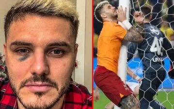 Video: el terrible accidente que sufrió Mauro Icardi en el rostro y que preocupó a Wanda Nara