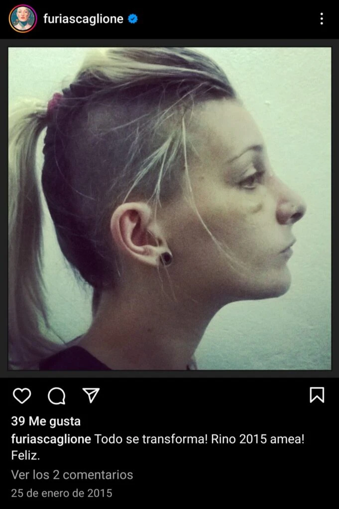 ASI QUEDO FURIA AL SALIR DEL QUIROFANO TRAS LA RINOPLASTIA