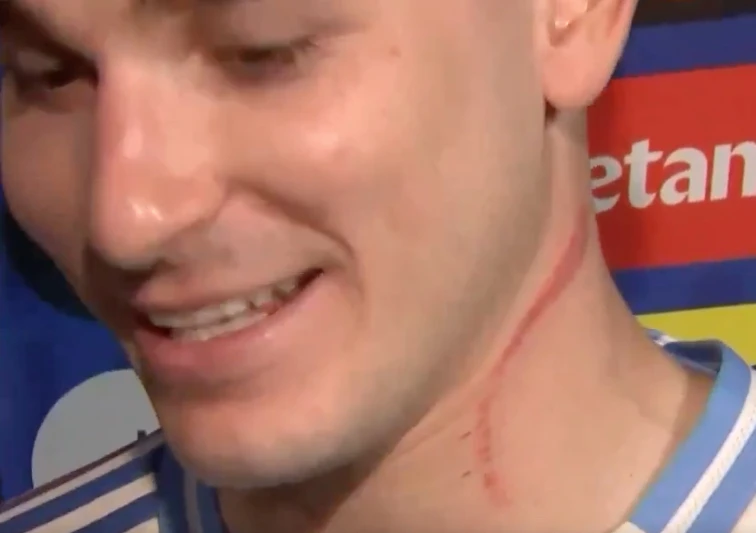 ¿Y ESO? NO, NO ERA UN "CHUPON". A JULIAN LE QUEDO ESA MARCA EN EL CUELLO TRAS "ROZAR" CON UN DEFENSOR CANADIENSE. COSAS DEL FUTBOL.