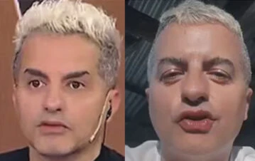 Así quedó Angel de Brito tras sufrir un  "accidente" en sus vacaciones patagónicas: "Tiene los labios de Wanda"