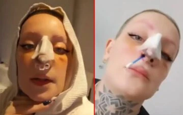 El problema que sufre Furia luego de hacerse una cirugía estética en la nariz