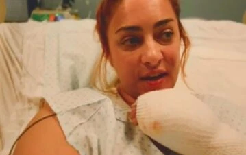 “Re quemada”: Cuánta parte del cuerpo le quedó comprometida a María Julia Olivan tras el incendio que sufrió en su casa