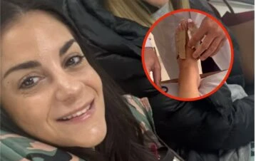 ¡Qué impresión! A Emily Lucius le sacaron el juanete y mostró cómo le quedó el pie