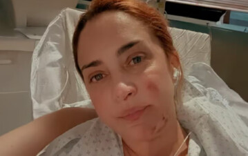 Las impactantes fotos de María Julia Oliván de cómo le quedó su cuerpo tras quemarse viva: “No se asusten”