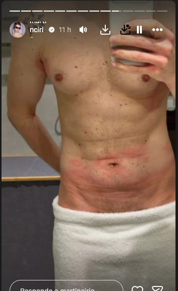 EL ABDOMEN DE CIRIO. Y ENCIMA NO SE PODIA RASCAR