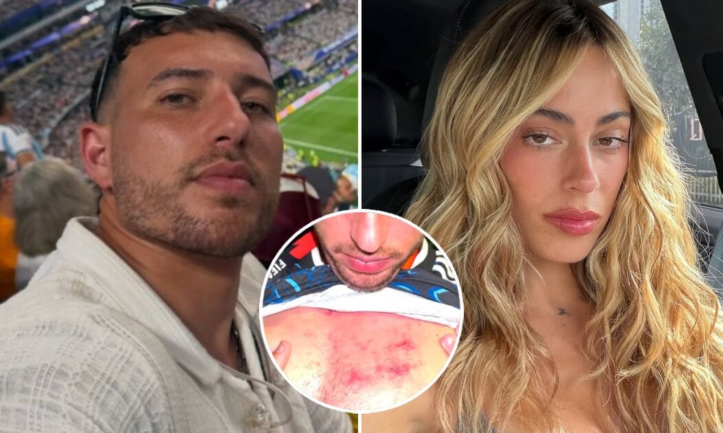 Así quedó el cuerpo de Martín Salwe tras ser agredido por la seguridad de Tini Stoessel: las fotos