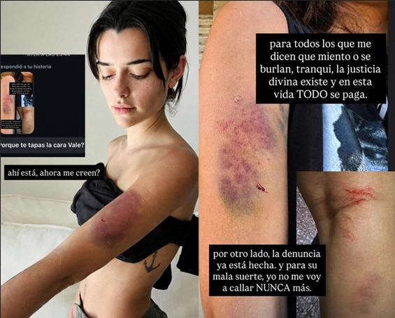 VALEN SALCEDO MOSTRO LOS MORETONES QUE LE QUEDARON TRAS SER AGREDIDA